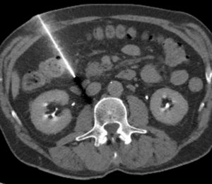 angers-radiologie-interventionnelle-2